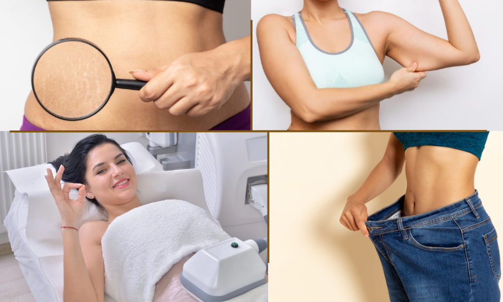 A collage of four images illustrating body contouring and skin treatment services offered by a clinic, showing concerns like stretch marks, sagging arm skin, and post-weight loss results, as well as a patient receiving a treatment.