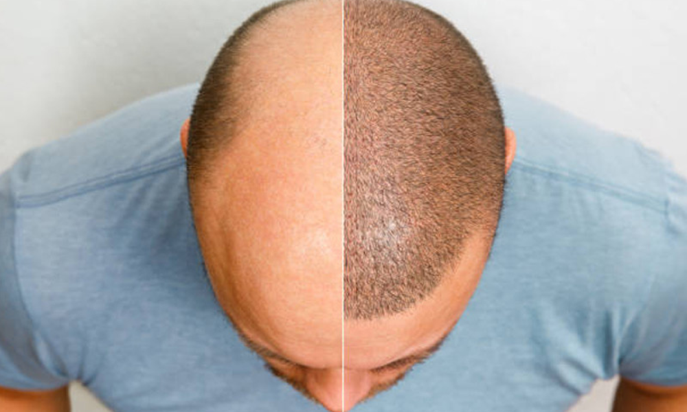 Before and after image of a man's scalp showing the results of a hair transplant procedure.