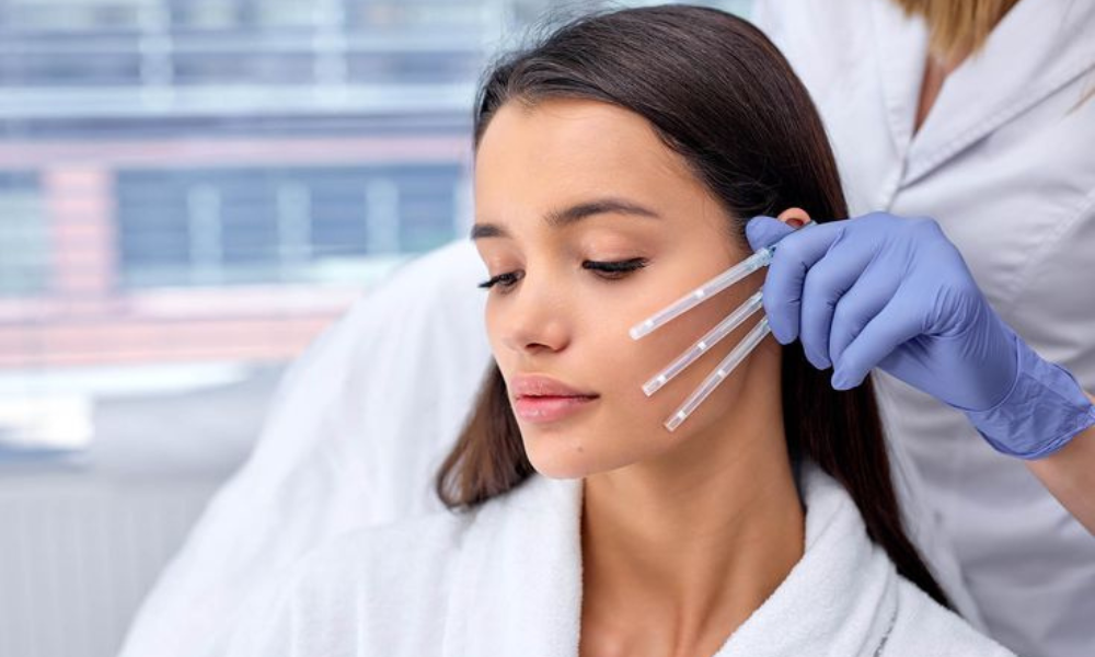 A person receiving a non-surgical facial thread lift, with small tubes containing the threads positioned on their cheek.