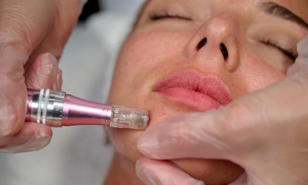 Close-up of a person receiving a microneedling facial treatment with a handheld pink device."