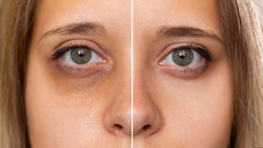How to Remove Dark Circles Permanently Without Surgery: Expert Solutions in Delhi